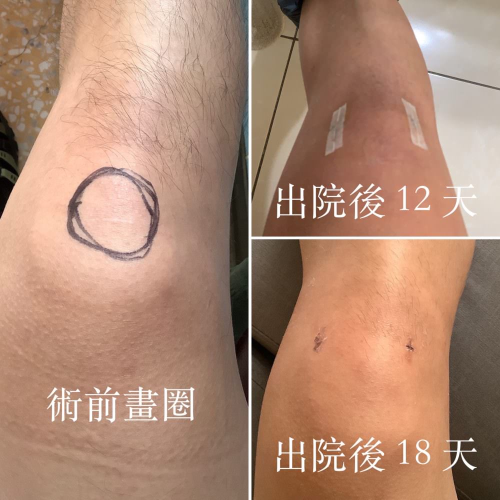 理賠 ⎮ 半月板碎裂,施打 PRP 增生療法有得賠? - 第2張圖 理賠 ⎮ 半月板碎裂,施打 PRP 增生療法有得賠?